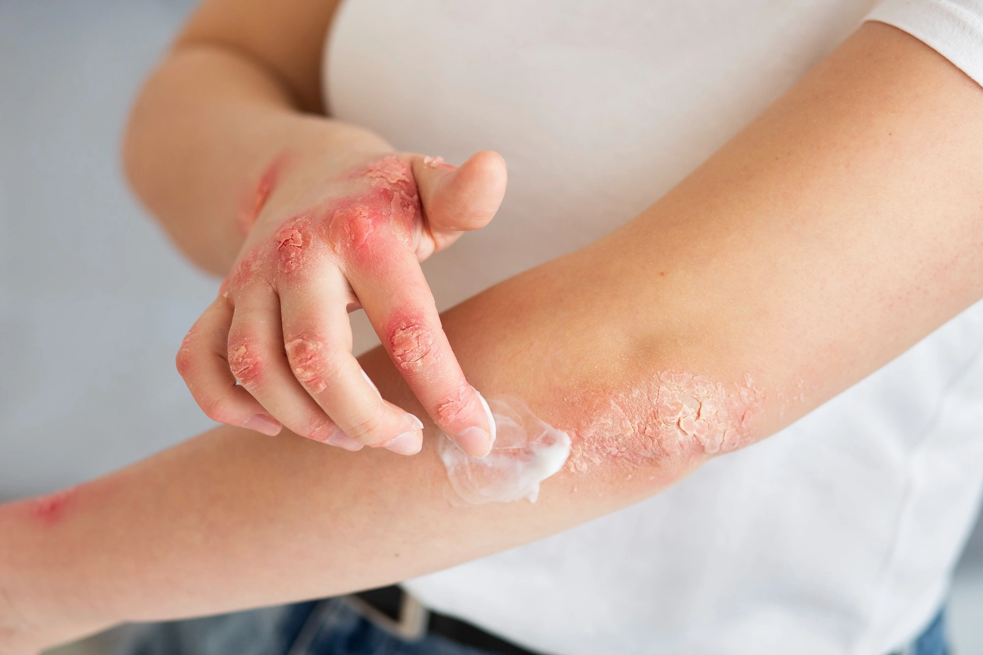 Alergias Cutáneas Dermatitis de Contacto